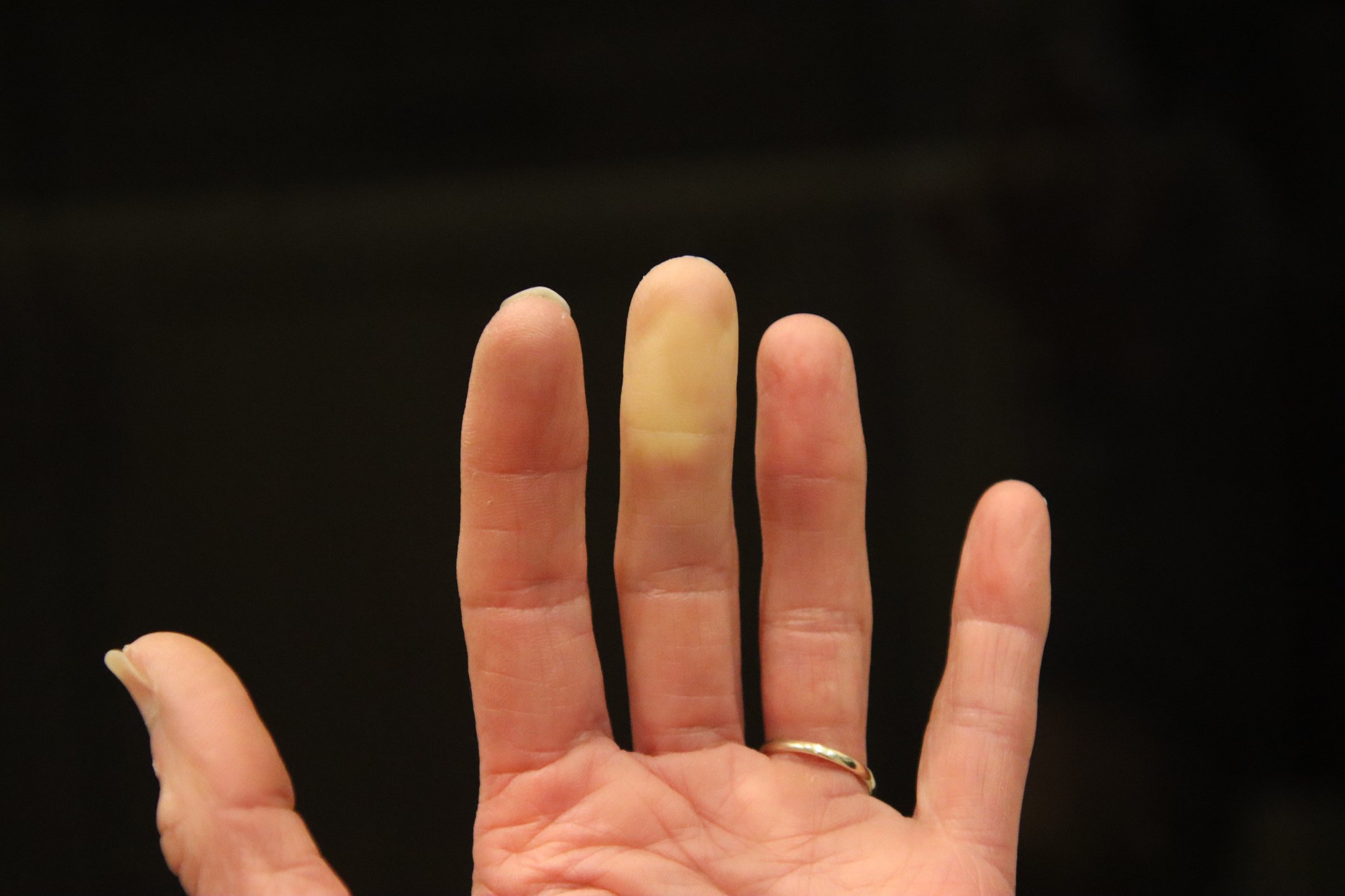 Picture of a hand with discolour to finger